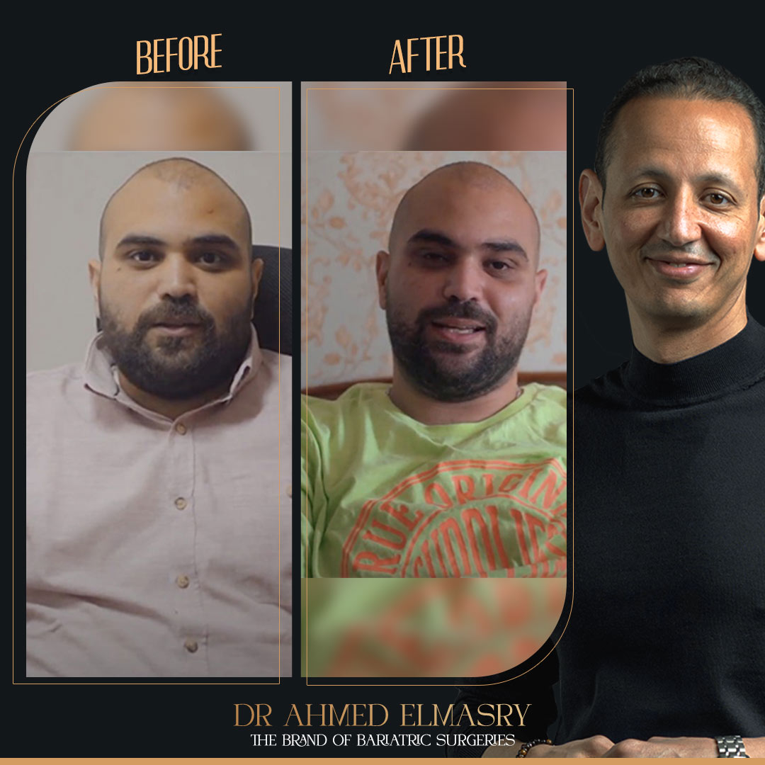 تجربتي مع تكميم المعدة بالمنظار